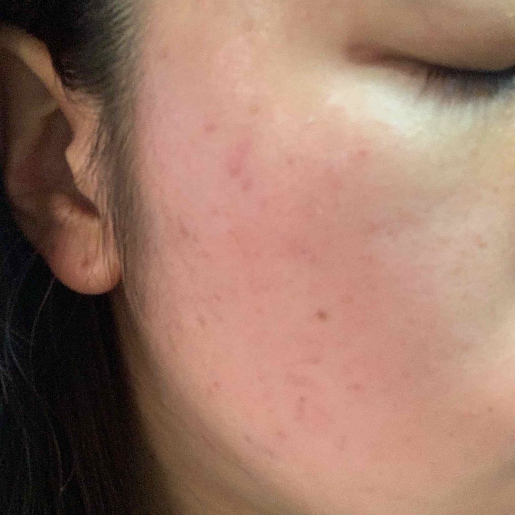 み さ き on LIPS 「⚠️1枚目以降ニキビ肌の写真があるので閲覧注意です…!!⚠️ま..」(3枚目)