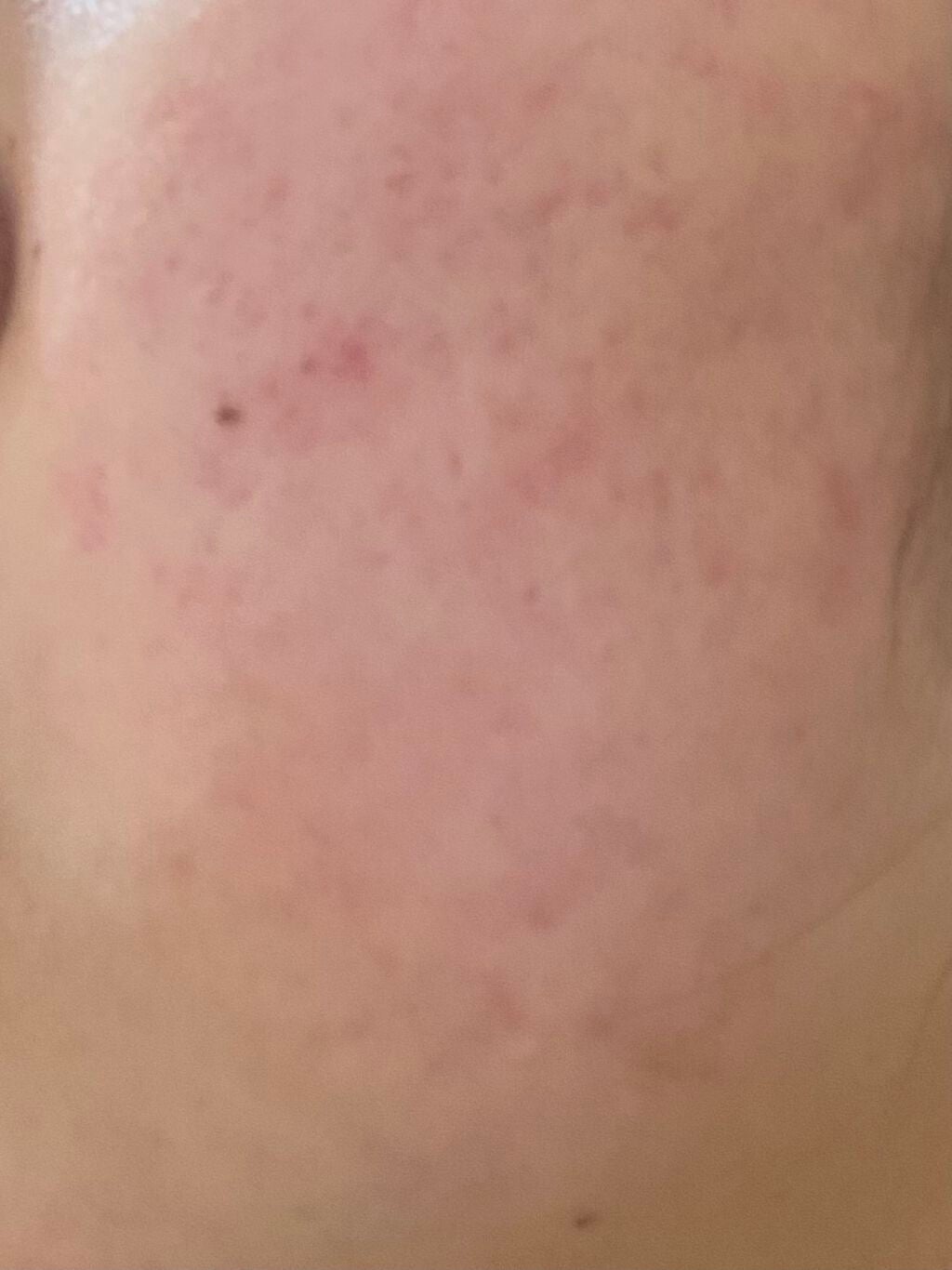 可愛くなりたい on LIPS 「(自分用 ニキビ記録)お風呂上がり最近荒れてて萎えてる..」(1枚目)