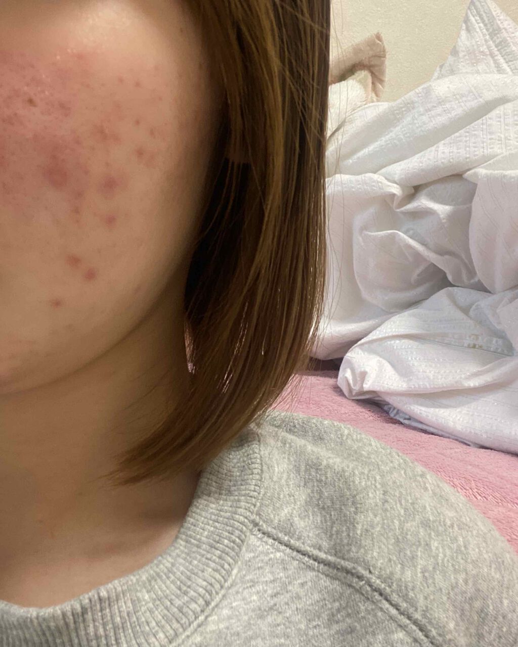 クリンダマイシンゲル(医薬品)/クラシエ薬品/その他を使ったクチコミ（2枚目）