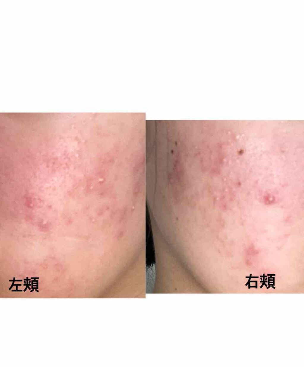 ゆたんぽ on LIPS 「肌荒れ助けてください😭😭高校1年生してます🙋♀️肌荒れには小..」(3枚目)