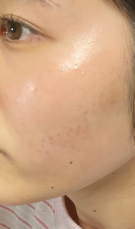 薬用しみ集中対策 プレミアム美容液/メラノCC/美容液を使ったクチコミ(5枚目)