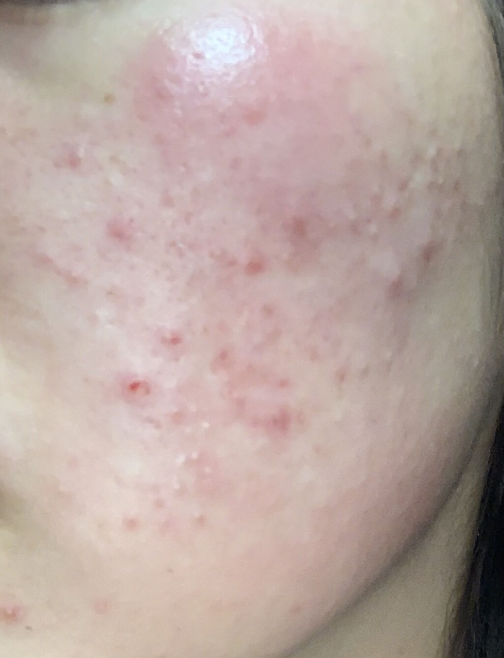 A アクネフォーム/NOV/洗顔フォームを使ったクチコミ（1枚目）