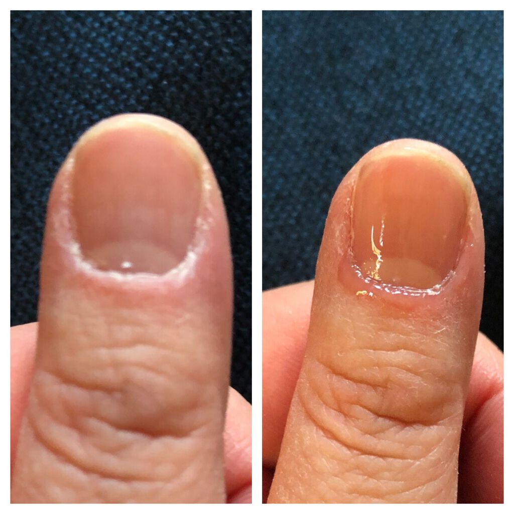 como ネイルセラム/コモエース/ネイルオイル・トリートメントを使ったクチコミ（3枚目）