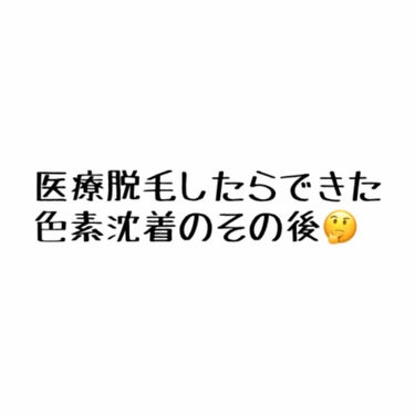 9月28日に医療脱毛を受けて色素沈着ができたその後の話です。色素沈着は消えたのか！？

結論から言うと半年経って「全て」は消えませんでした。
ですが右手はどこにあったのかすら分からないほど完璧に消えまし