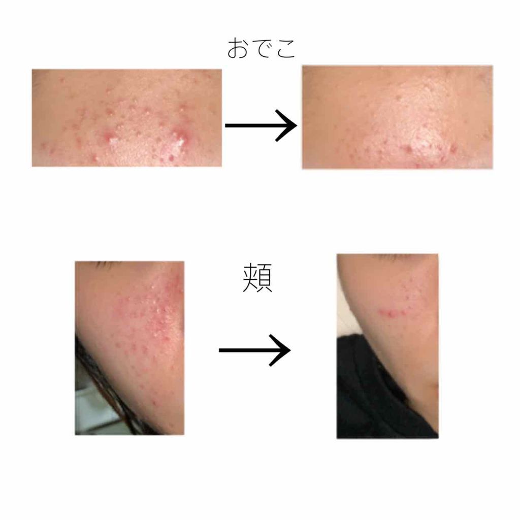 ペアアクネクリームW(医薬品)/ペア/その他を使ったクチコミ(3枚目)