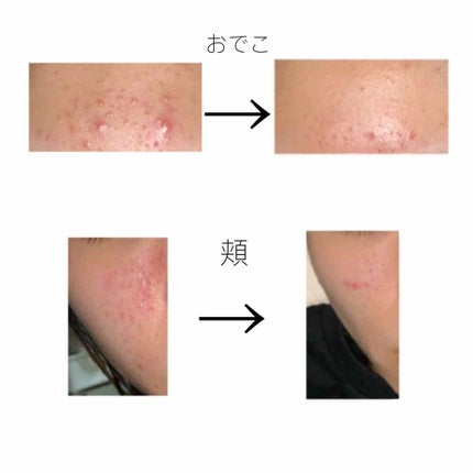 ãã¢ã¢ã¯ãã¯ãªãŒã W(å»è¬å)/ãã¢/ãã®ä»ã䜿ã£ãã¯ãã³ãïŒ3æç®ïŒ