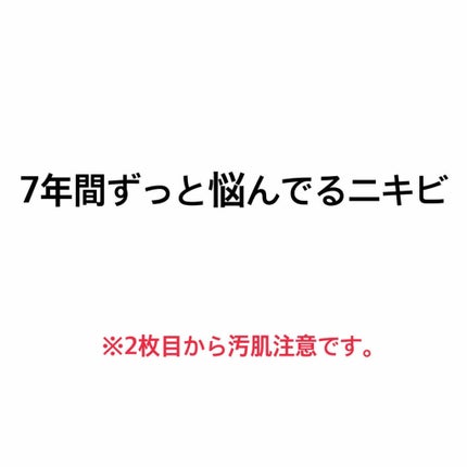 オードムーゲ 薬用ローション(ふきとり化粧水)/オードムーゲ/拭き取り化粧水を使ったクチコミ(1枚目)