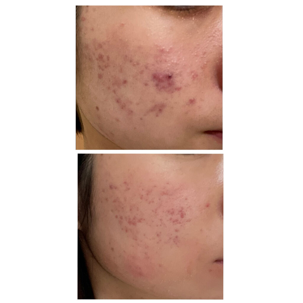 クリンダマイシンゲル(医薬品)/クラシエ薬品/その他を使ったクチコミ（2枚目）