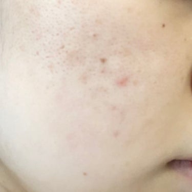 メラノCC 薬用しみ対策 美白化粧水 しっとりタイプのクチコミ「スキンケア記録
開始から2週間✨

洗顔を変え、乳液を付けるようにしました。

洗顔→ロゼット.....」（3枚目）