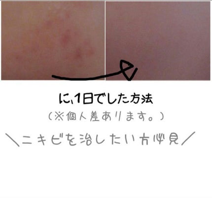 ペアアクネクリームW(医薬品)/ペア/その他を使ったクチコミ(1枚目)