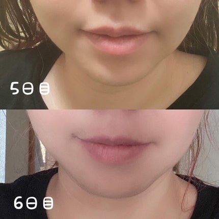 ちっちみ on LIPS 「。*♡……♡*。。*♡……♡*。1週間経ったので、ボトックスの..」(4枚目)