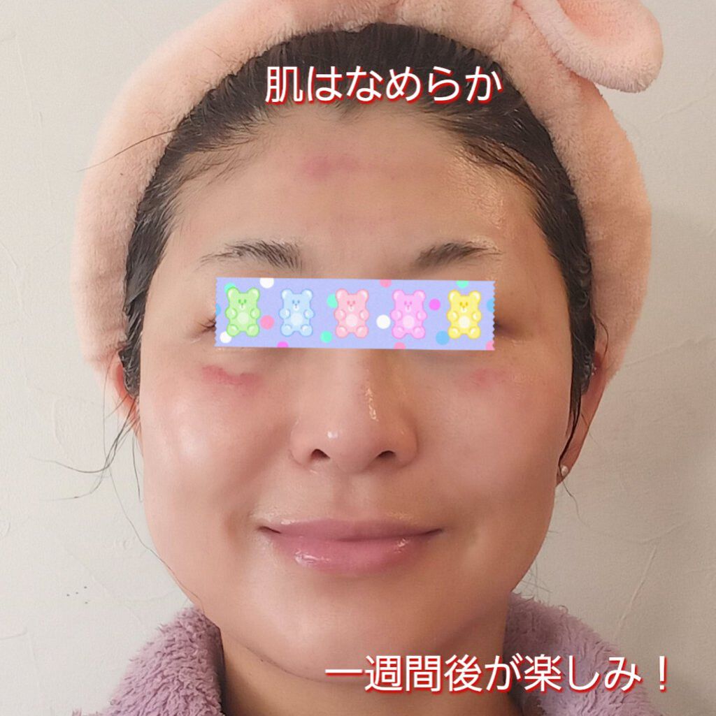 ダーマペン・ダーマスタンプ/MyM/その他スキンケアグッズを使ったクチコミ（3枚目）