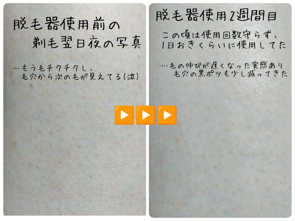 2PS/Qoo10/家庭用脱毛器を使ったクチコミ(7枚目)