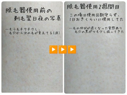 2PS/Qoo10/家庭用脱毛器を使ったクチコミ(7枚目)