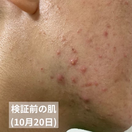 ペアアクネクリームW(医薬品)/ペア/その他を使ったクチコミ(3枚目)