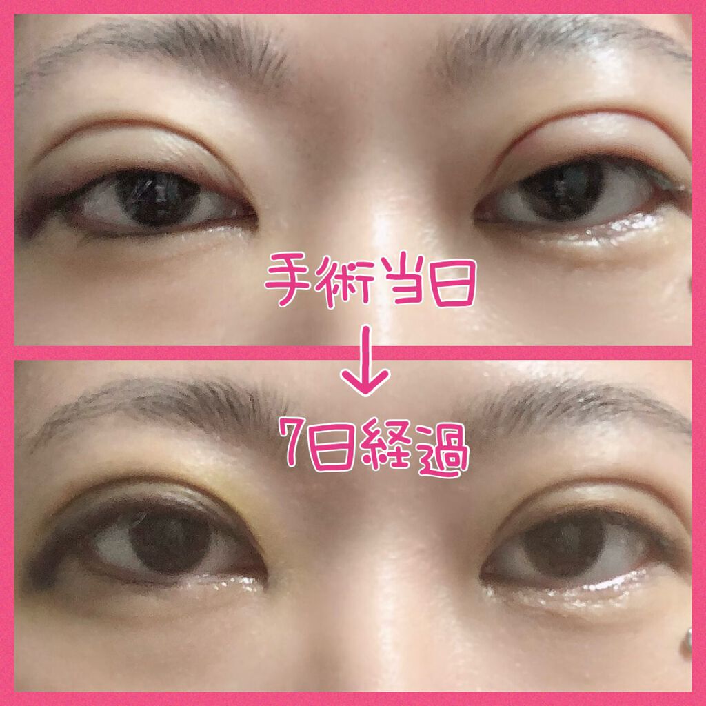 みぃ♔相互フォロー100% on LIPS 「※目の写真注意おはようございます🐣早くも7日が経過しました…4..」(5枚目)