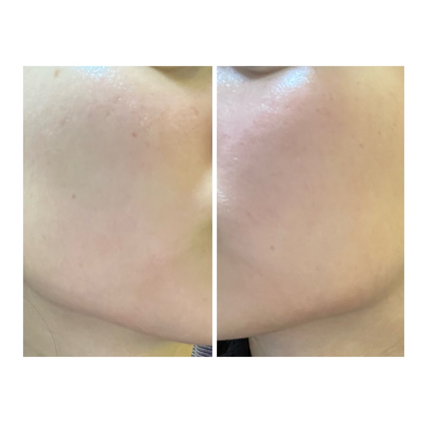 ぽむ on LIPS 「2023.9.13皮膚科に受診 エピデュオとヘパリン処方1枚目..」(2枚目)