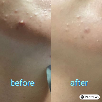 薬用ニキビケア スポッツクリーム/アクネスラボ/フェイスクリームを使ったクチコミ(1枚目)