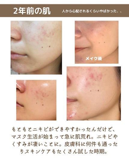 enuko | 美容オタク on LIPS 「【実は1年前までニキビ肌でした🤫】もともとニキビはできやすかっ..」(3枚目)