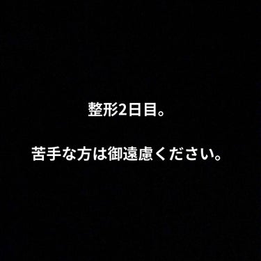 整形2日目。

そしてメイク有り。

夜のお店にこの状態で出勤し、
お客様にも、キャストにも
整形後っていうことは、
気づかれませんでした😅✨

アイラインは、
めっちゃ太めに書いた記憶があります。

