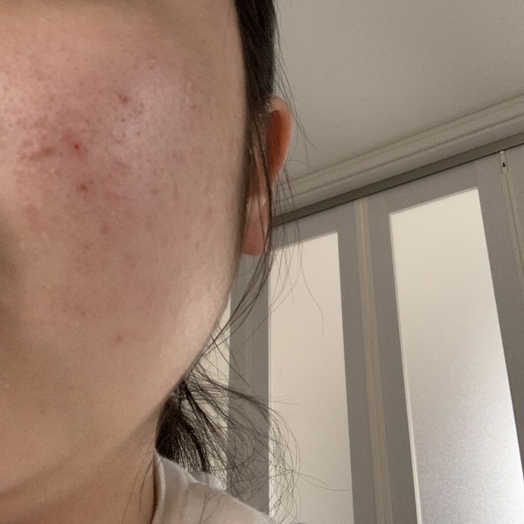 ノブ Ａ アクネソープ/NOV/洗顔石鹸を使ったクチコミ（2枚目）