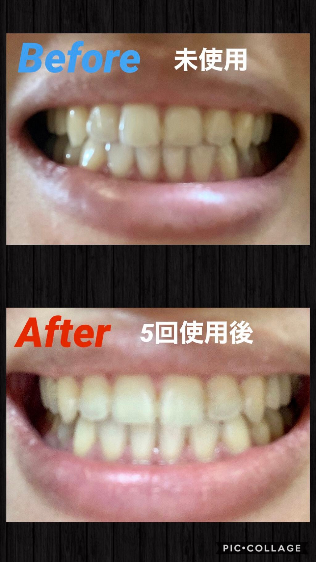 スーパーホワイトニングゲル/デンタルラバー/その他オーラルケアを使ったクチコミ(3枚目)