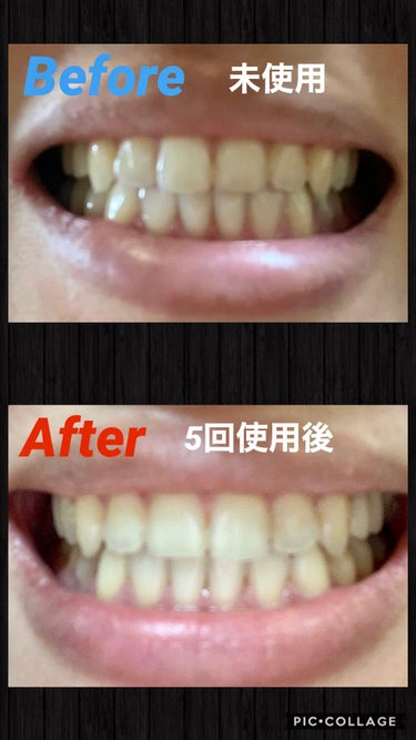 スーパーホワイトニングゲル|デンタルラバーの使い方を徹底解説