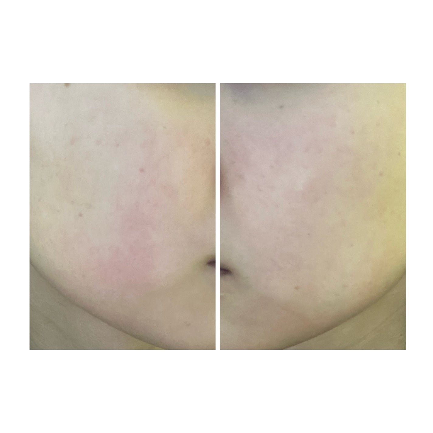 ぽむ on LIPS 「2023.9.13皮膚科に受診 エピデュオとヘパリン処方1枚目..」(1枚目)