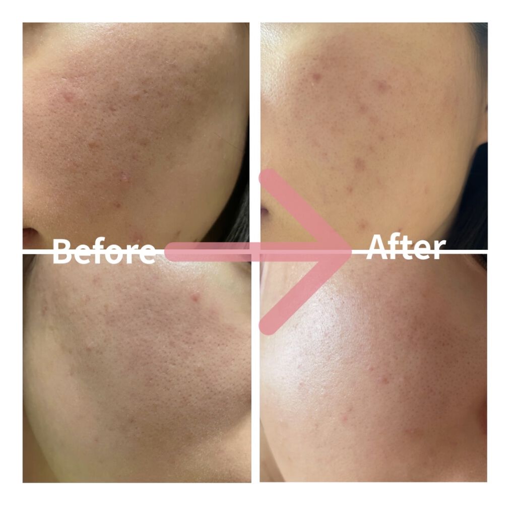 薬用しみ集中対策 プレミアム美容液/メラノCC/美容液を使ったクチコミ（2枚目）