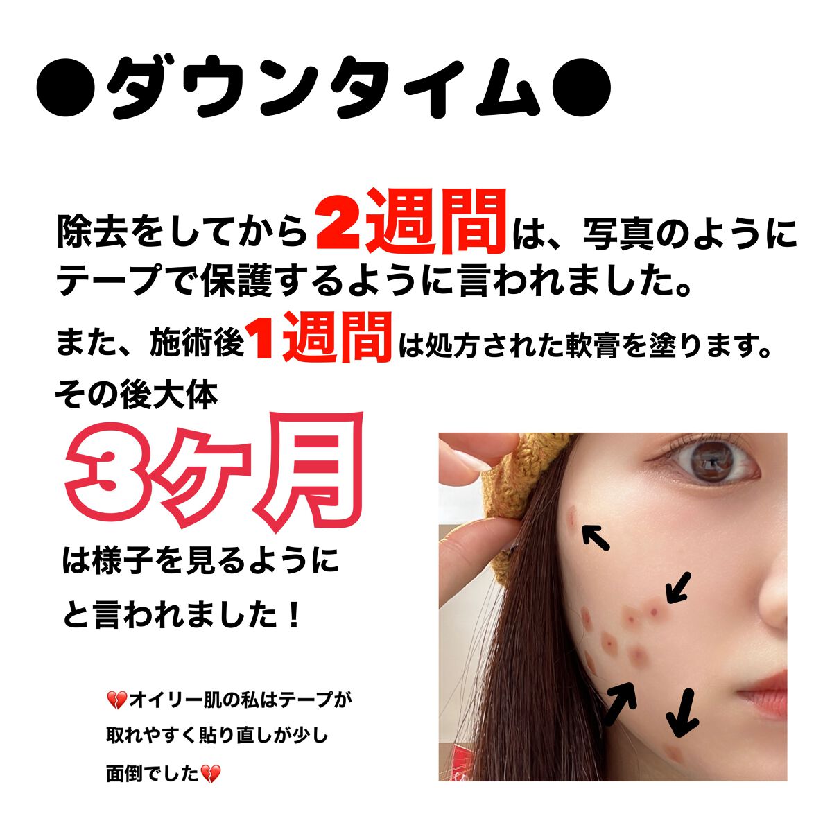 Kana on LIPS 「マスク解禁前にほくろとおさらば!!ほくろ除去レポです🙌まだ除去..」(5枚目)