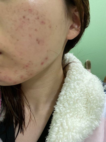 ティーツリーケアソリューション アンプルマスクJEX/MEDIHEAL/シートマスク・パックを使ったクチコミ(3枚目)