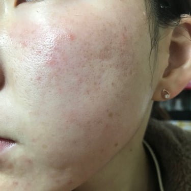 Glucolic Acid 30% Gel Peel/YEOUTH/ピーリングを使ったクチコミ（2枚目）