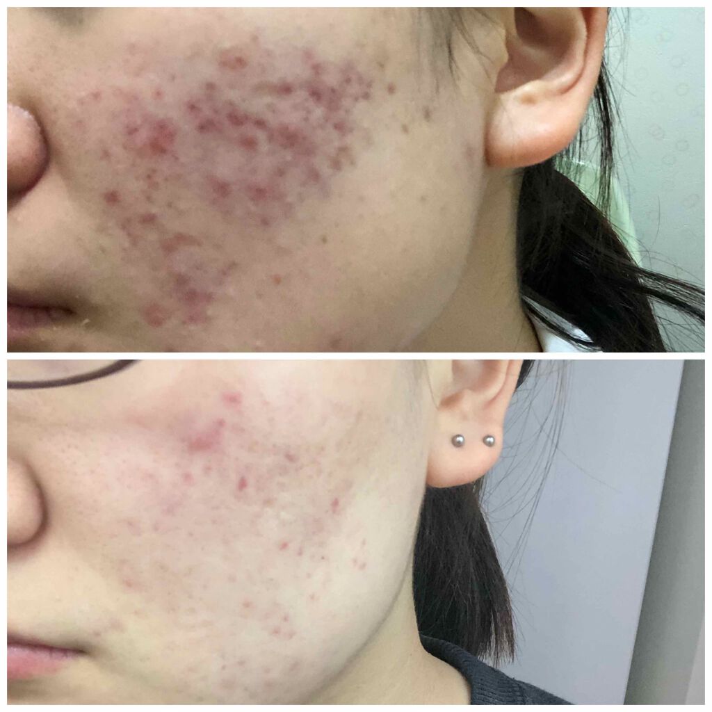 オードムーゲ 薬用ローション（ふきとり化粧水）/オードムーゲ/拭き取り化粧水を使ったクチコミ（1枚目）