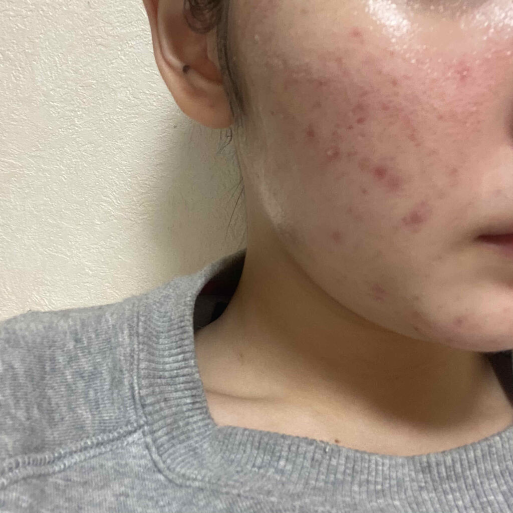 クリンダマイシンゲル(医薬品)/クラシエ薬品/その他を使ったクチコミ（1枚目）