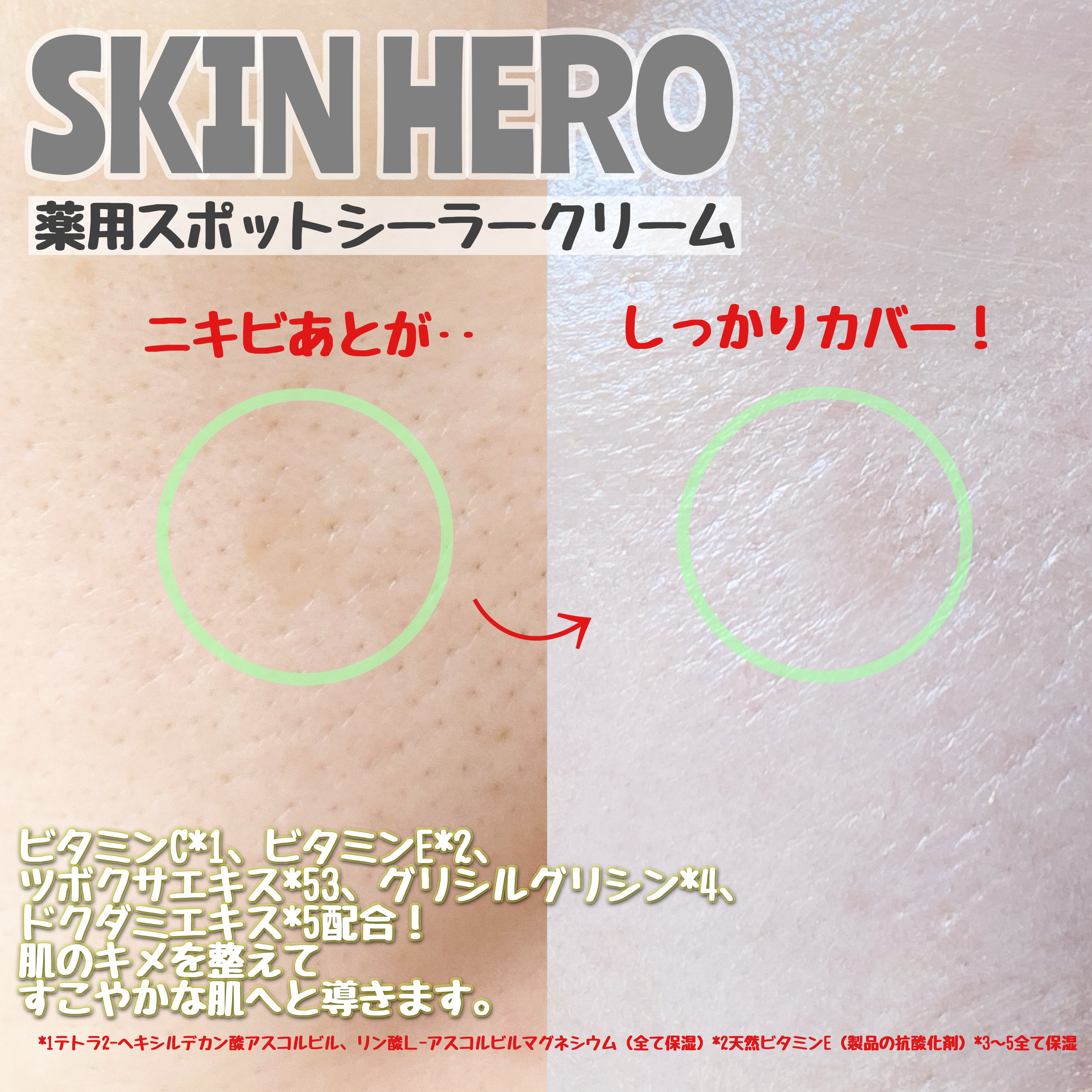 薬用スポットシーラークリーム/スキンヒーロー/クリームコンシーラーを使ったクチコミ（3枚目）