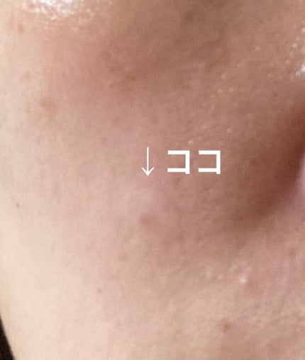 極薄透明パッチ nikipa!/金冠堂/にきびパッチを使ったクチコミ(3枚目)