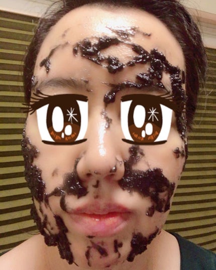 ニードル炭酸パック/NNE/洗い流すパック・マスクを使ったクチコミ(5枚目)