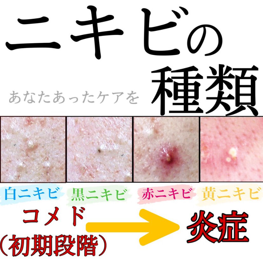 ペアアクネクリームW(医薬品)/ペア/その他を使ったクチコミ(1枚目)