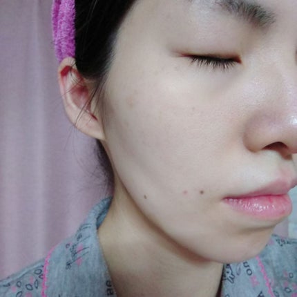 薬用3ステップセット30日サイズ/プロアクティブ/トライアルキットを使ったクチコミ(4枚目)