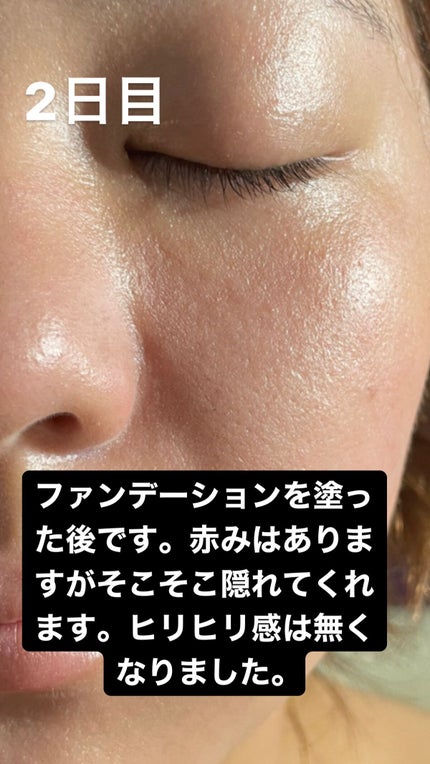 まなみ on LIPS 「ダーマペン4毛穴やクレーターなどに効く美容医療です。私は毛穴の..」(3枚目)