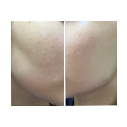 ぽむ on LIPS 「2023.9.13皮膚科に受診 エピデュオとヘパリン処方1枚目..」(1枚目)