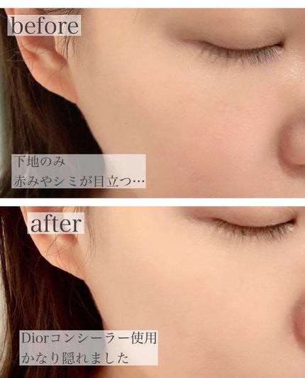 【旧】ディオールスキン フォーエヴァー スキン コレクト コンシーラー/Dior/リキッドコンシーラーを使ったクチコミ(4枚目)