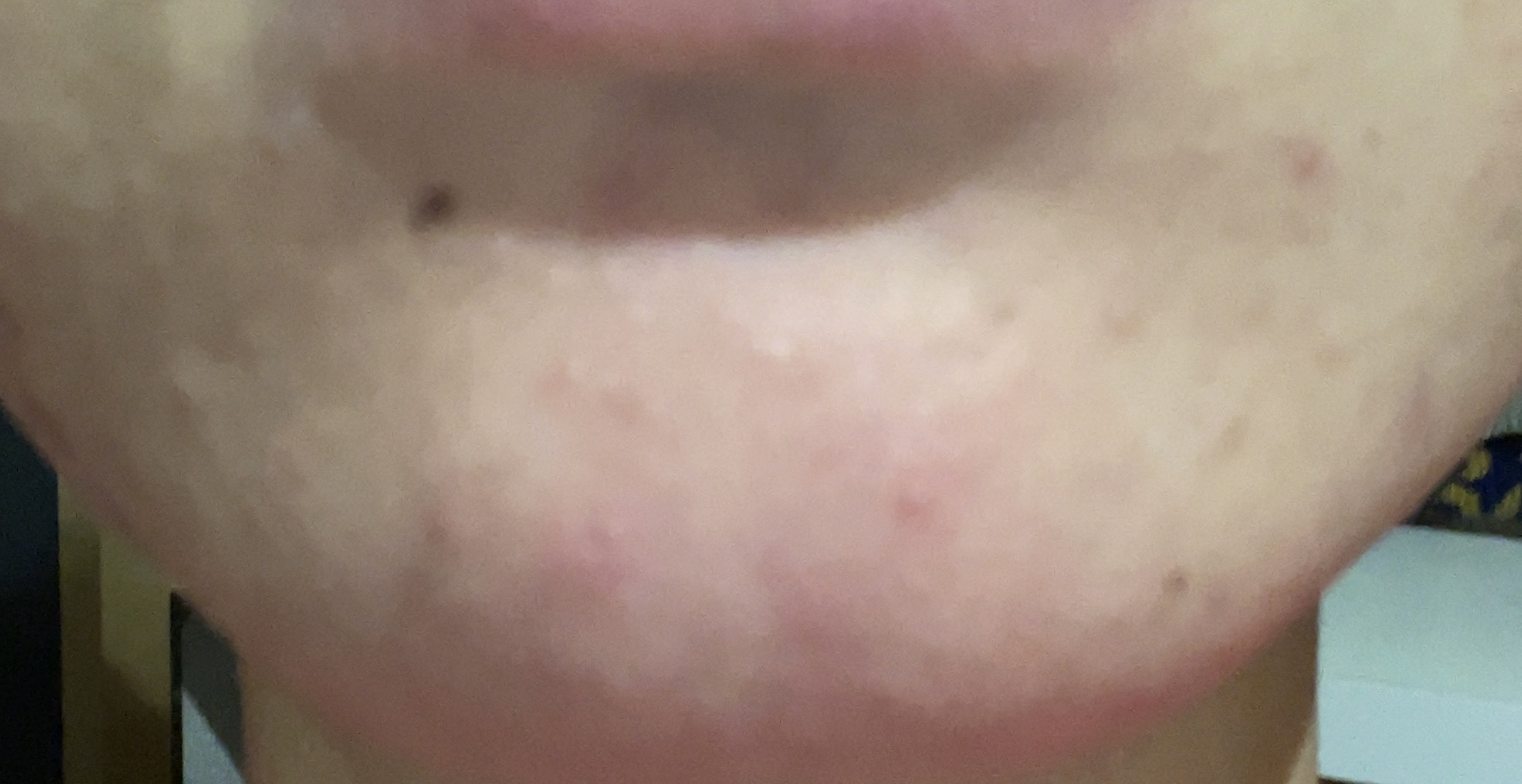 皮脂トラブルケア 保湿ジェル/キュレル/化粧水を使ったクチコミ（2枚目）