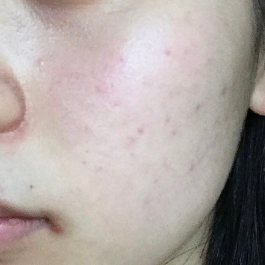 薬用 しみ 集中対策 美容液/メラノCC/美容液を使ったクチコミ(1枚目)