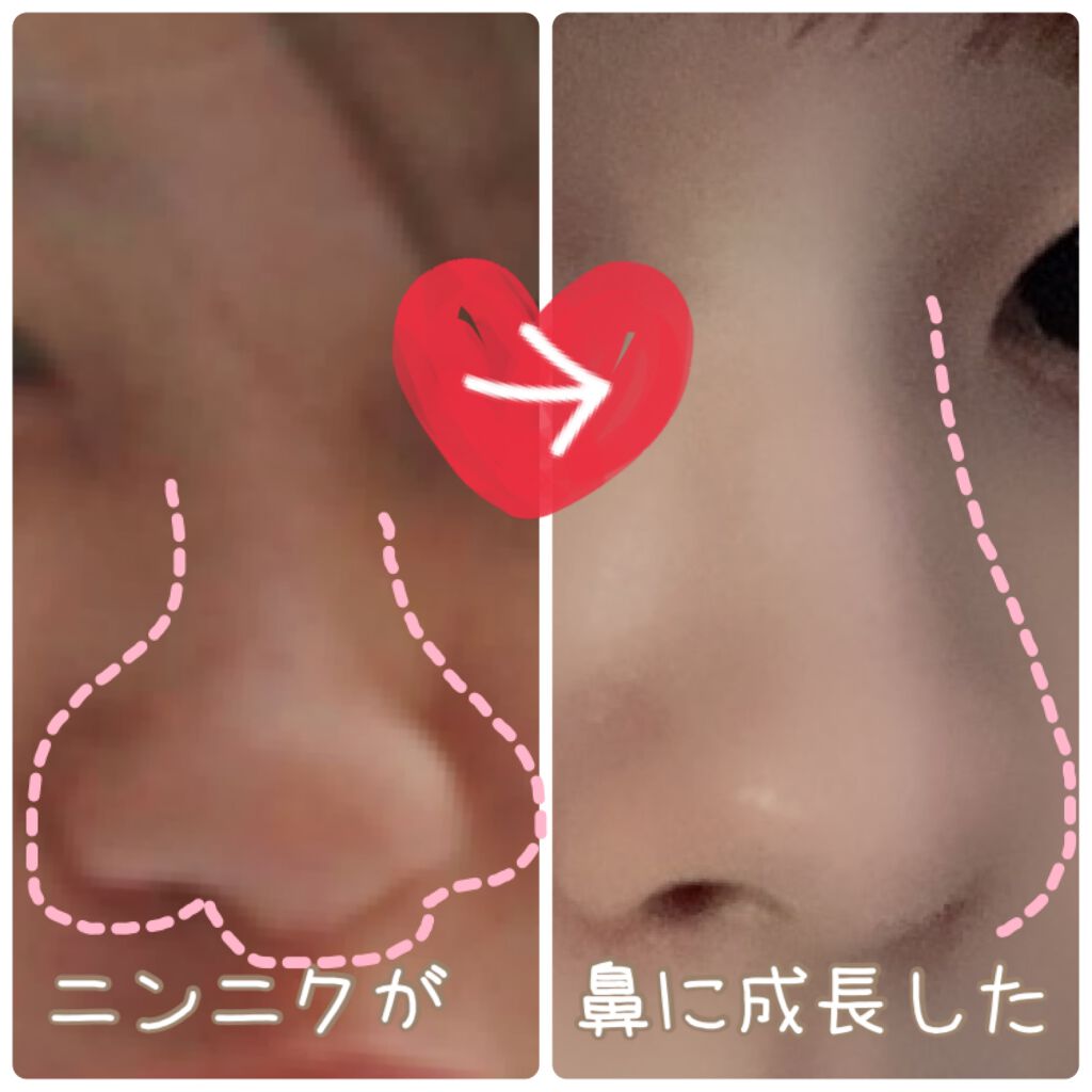 美鼻セレブ ノーズクリップ|O.M.C TOKYOの口コミ「整形せずに鼻高く/最近会う人会う人みんなに..」 by ゆの(敏感肌/20代後半) | LIPS 美鼻セレブ ノーズクリップ|O.M.C TOKYOの口コミ「整形せずに鼻高く/最近会う人会う人みんなに..」 by ゆの(敏感肌/20代後半) | LIPS