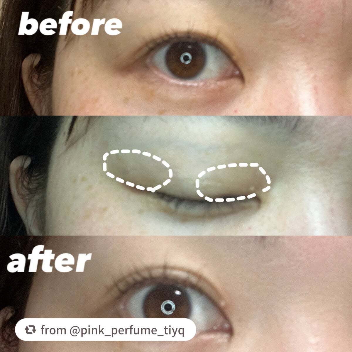 TWOOL ダブルアイリッドグルー/SHOBIDO/二重まぶた用アイテムを使ったクチコミ(2枚目)