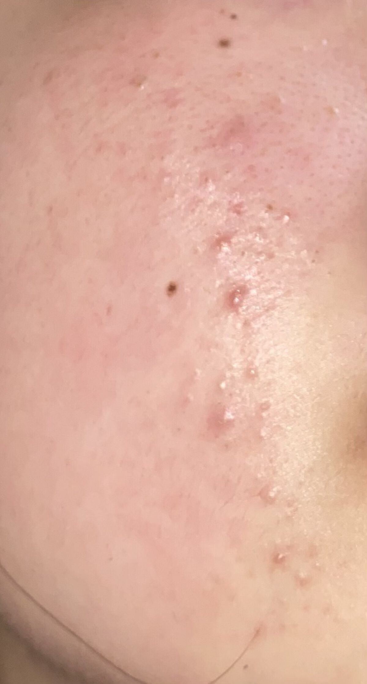 ACアクティブ トライアルセット/NOV/トライアルキットを使ったクチコミ（1枚目）