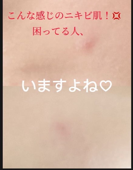 ダーマレーザー ウルセラC/クオリティファースト/美容液を使ったクチコミ（2枚目）