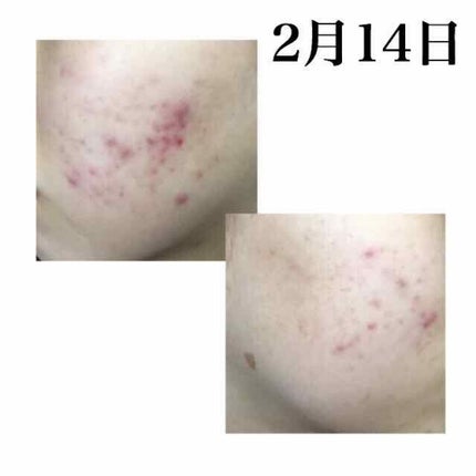 薬用 しみ 集中対策 美容液/メラノCC/美容液を使ったクチコミ(3枚目)