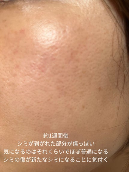 侘助 on LIPS 「【美容医療でシミ取り記録】こんにちは、侘助です❁❁❁今回は美容..」(7枚目)